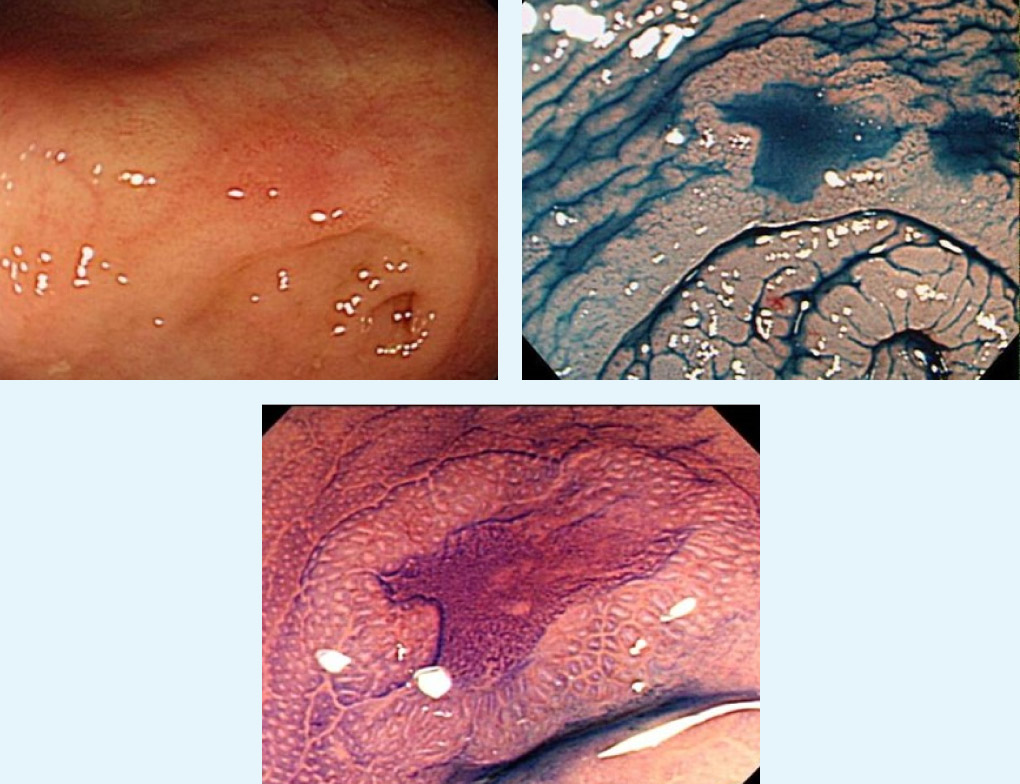陥凹型大腸癌の早期がんを見逃しません