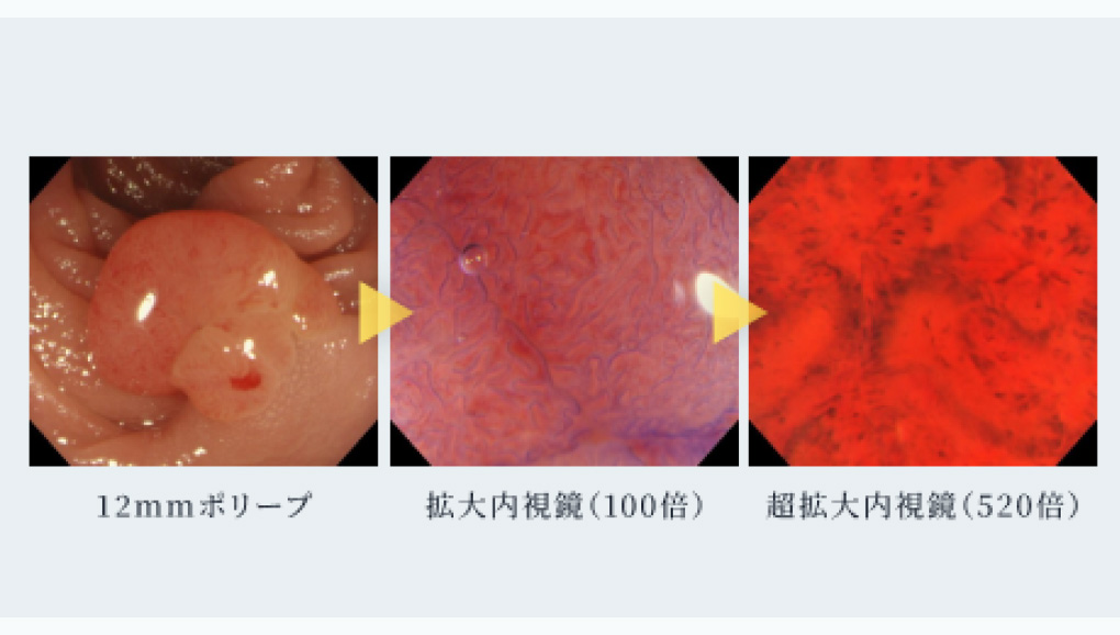 拡大内視鏡・超拡大内視鏡による診断