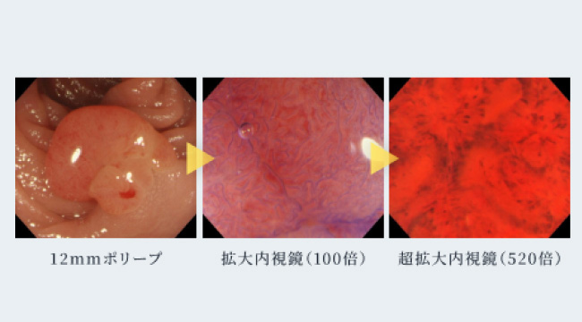 拡大内視鏡・超拡大内視鏡による診断